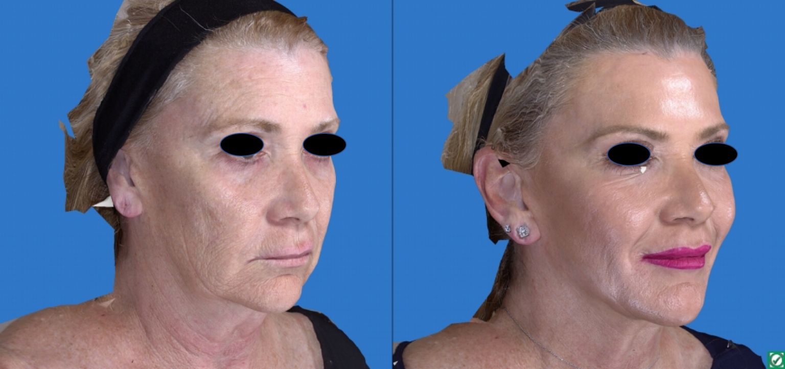 Laser Skin Resurfacing Pasadena Los Angeles CA