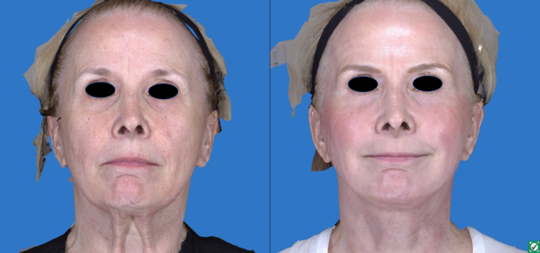 Laser Skin Resurfacing Pasadena Los Angeles CA