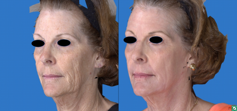 Laser Skin Resurfacing Pasadena Los Angeles CA